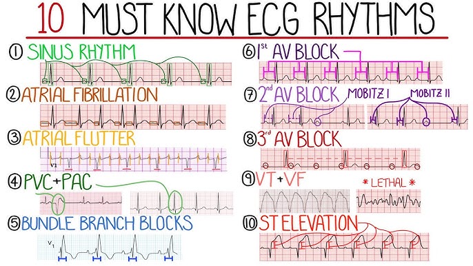 Must Know ECG SetelDoc