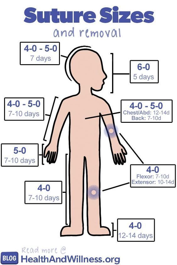 Suture Thread Needle Size and Suture to Open SetelDoc